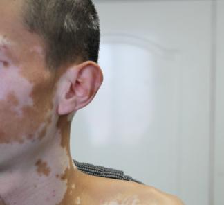 轻视白癜风2年，“疯长时方悔恨”