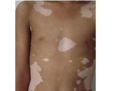 白癜风的危害有多大