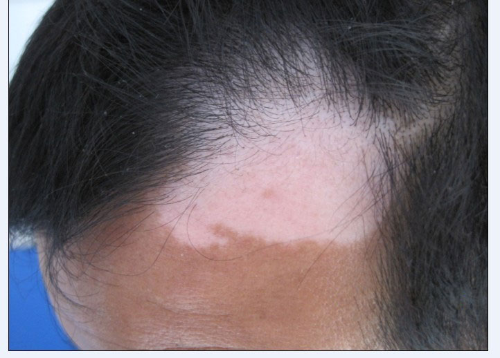 白癜风头部的症状有哪些呢