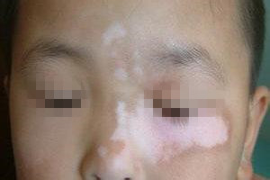 白癜风应该如何治疗才科学