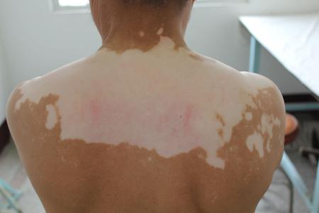 白癜风治疗措施有哪些